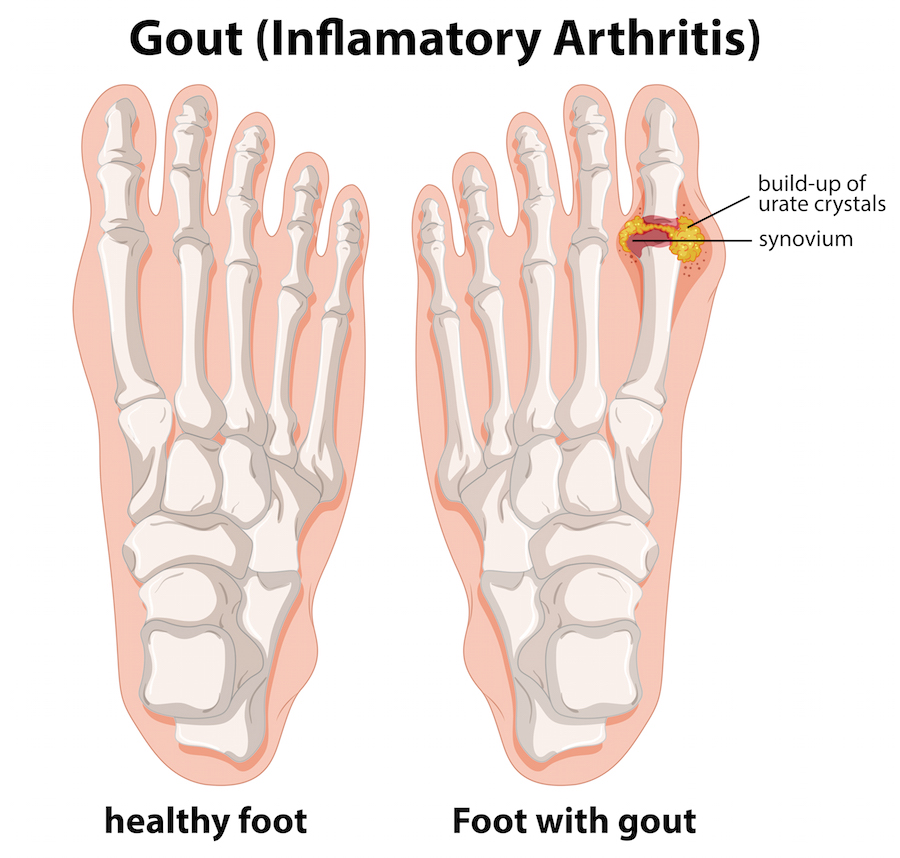 Foot Gout Treatment In Frisco Texas Rnv Podiatry