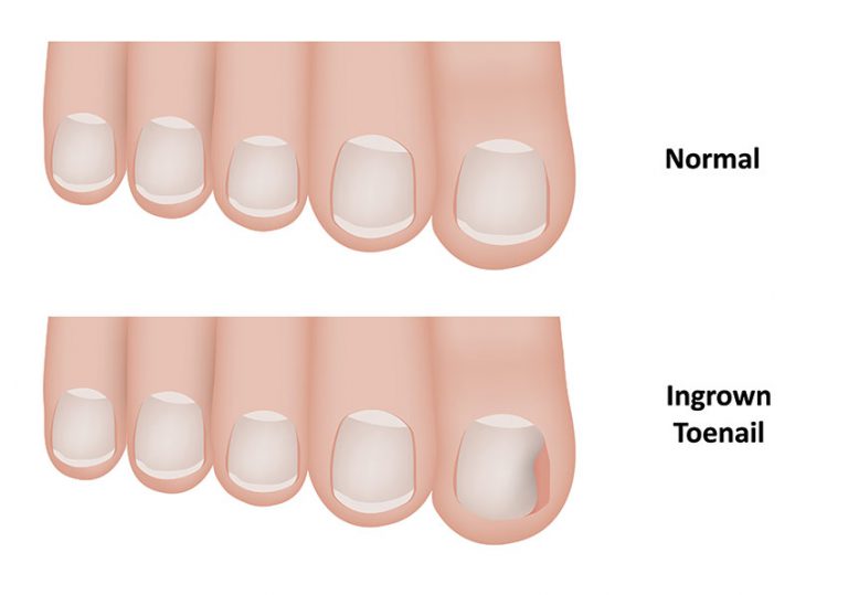 Ingrown Toenail Treatment in Frisco | RNV Podiatry