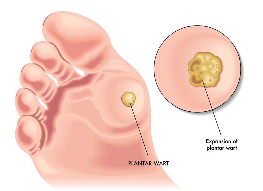 wart on foot symptoms este posibilă îndepărtarea papilomelor cryopharm