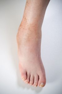 Picture of unusual foot