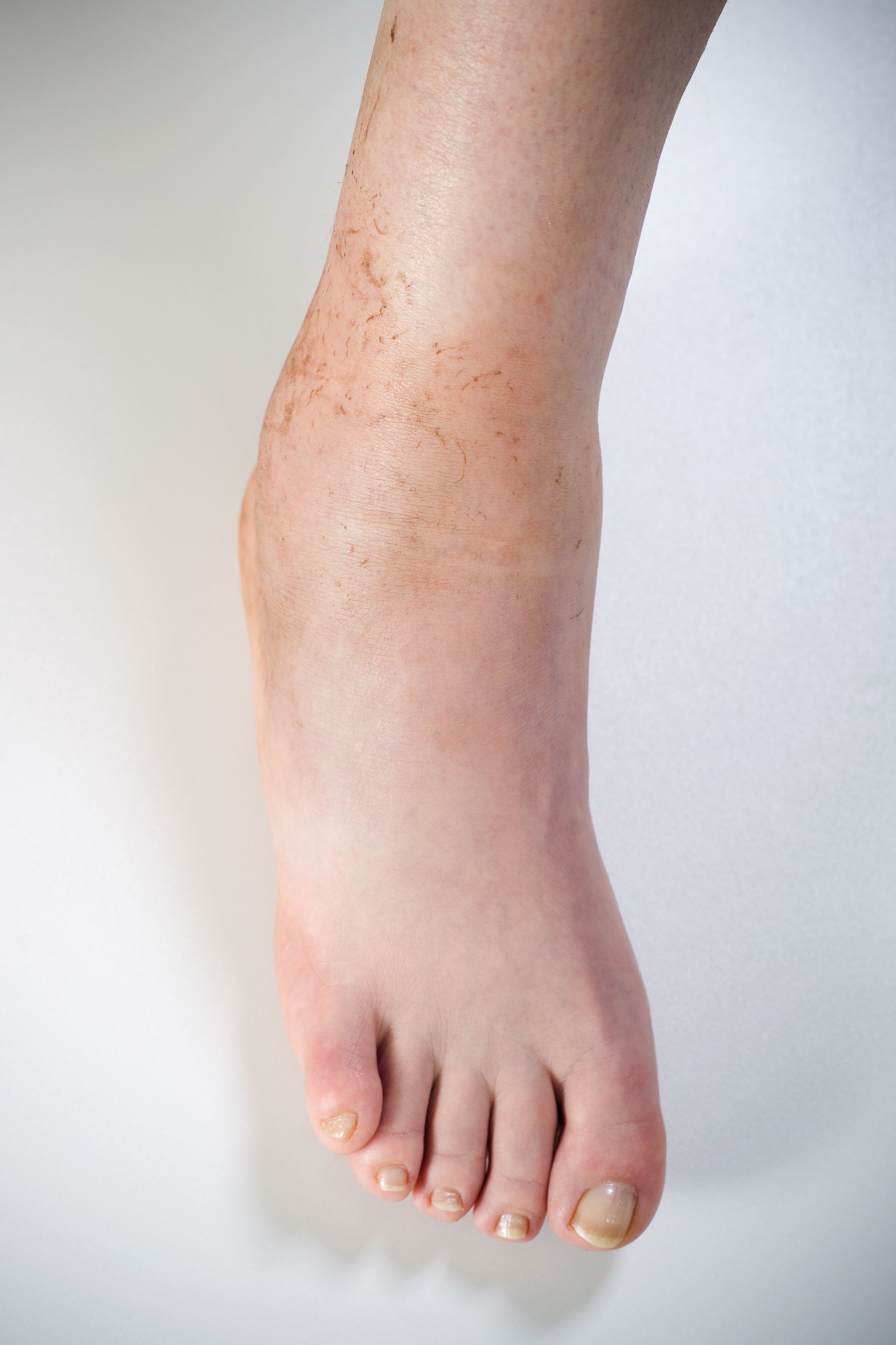 close-up-of-swollen-foot-rnvpodiatry