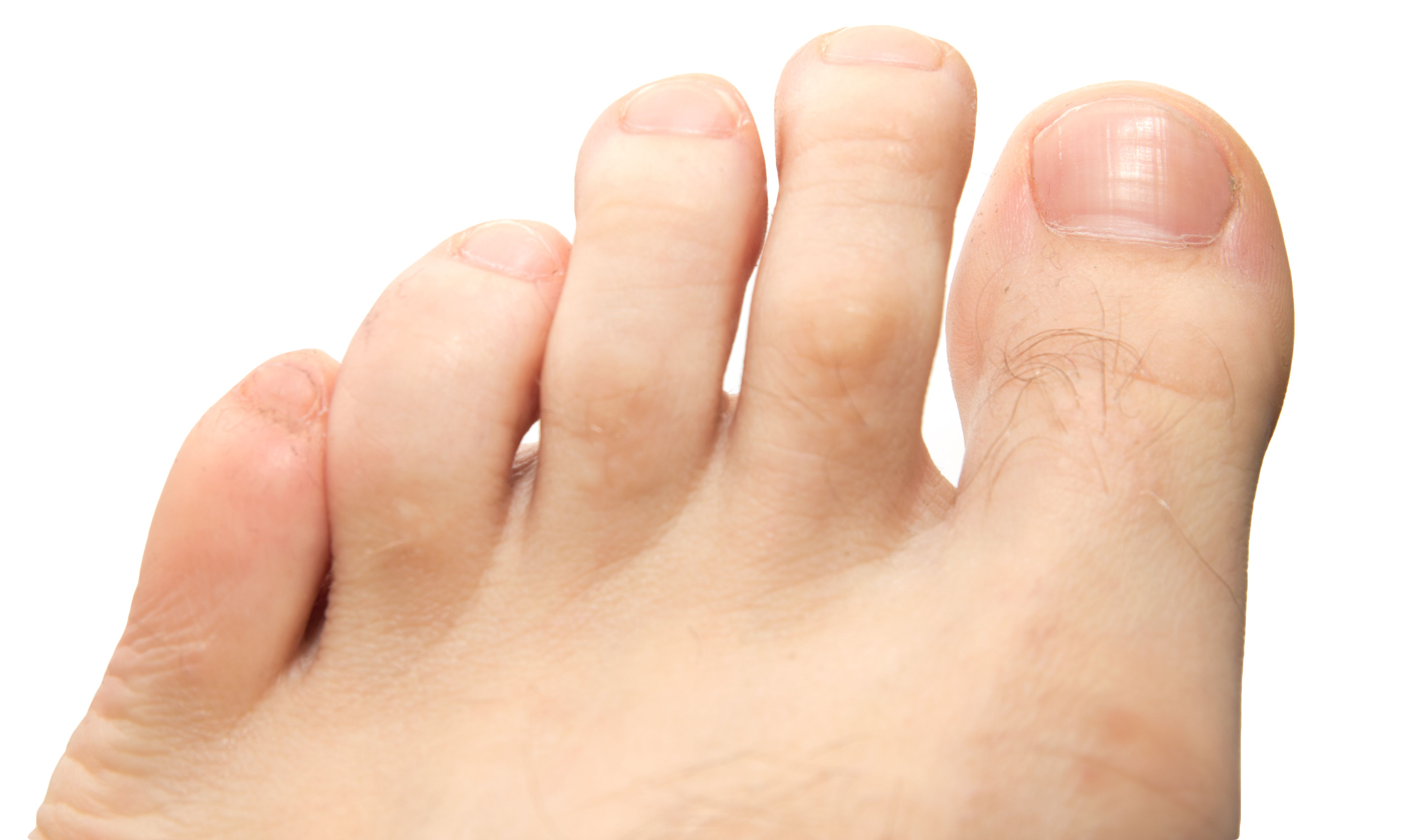 Wart foot pain