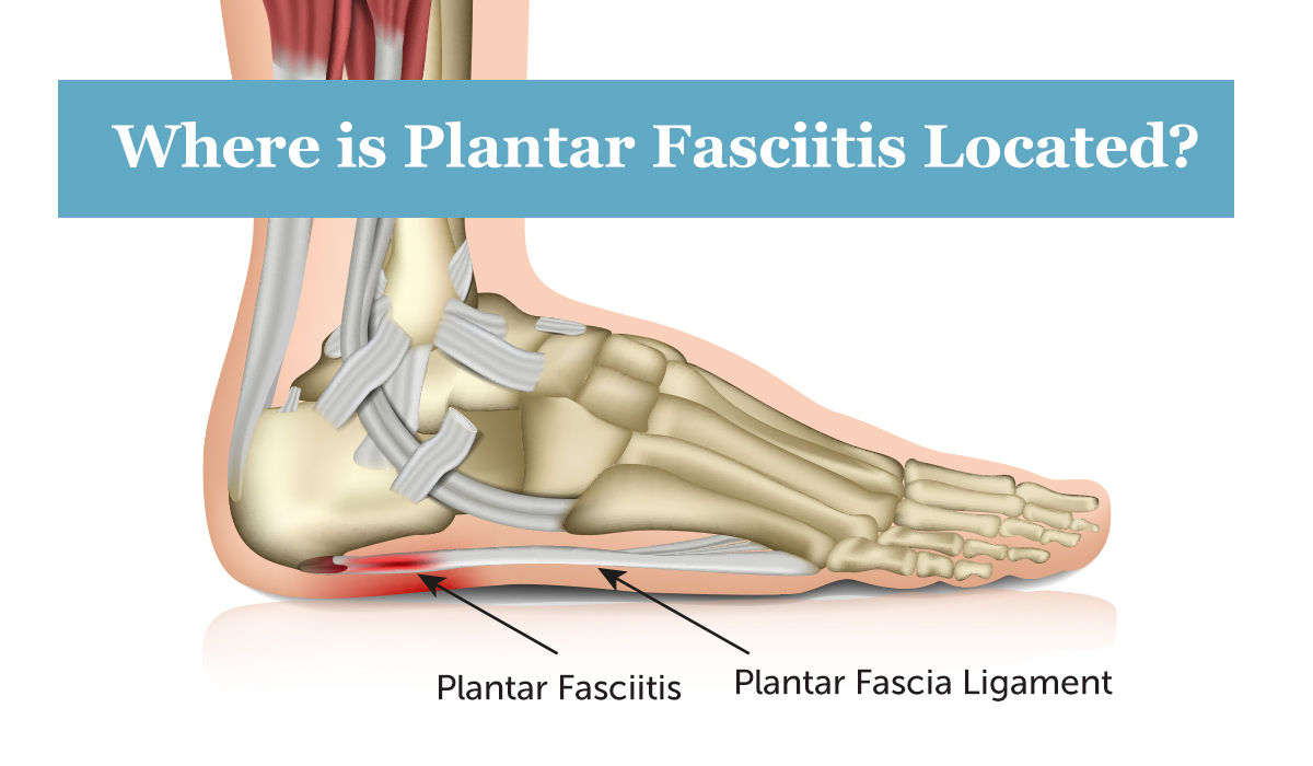 planters fasciitis treatment